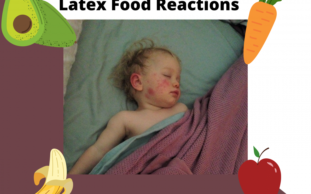 Latex Food Reactions: It’s A Thing! Ep 7 Transcript